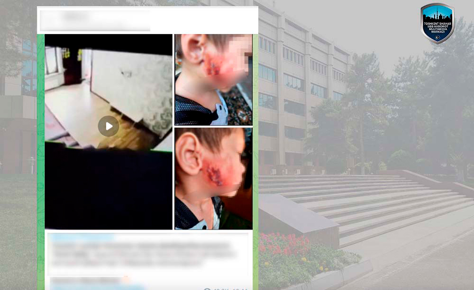 В ГУВД прокомментировали видео ребенка со страшными ожогами, полученными в ташкентском детсаду  